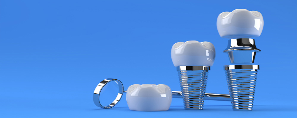 Diş implant tedavisi ne kadar sürer?