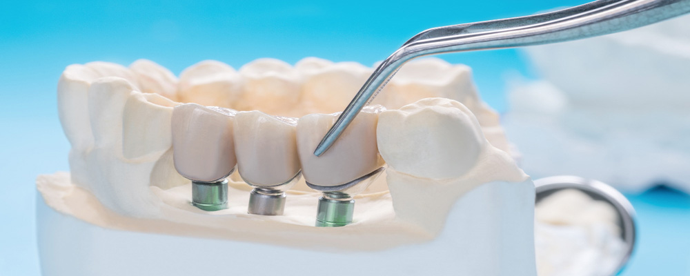 Implant diş bakımı nasıl yapılır?