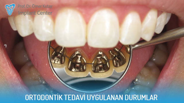 Ortodontik Tedavi Uygulanan Durumlar