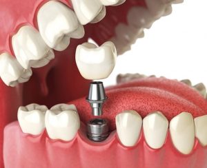 Diş takma işlemi nasıl yapılır?