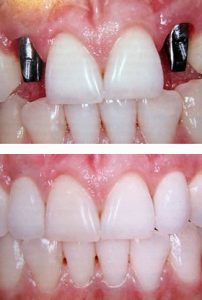 implant ve doğal diş