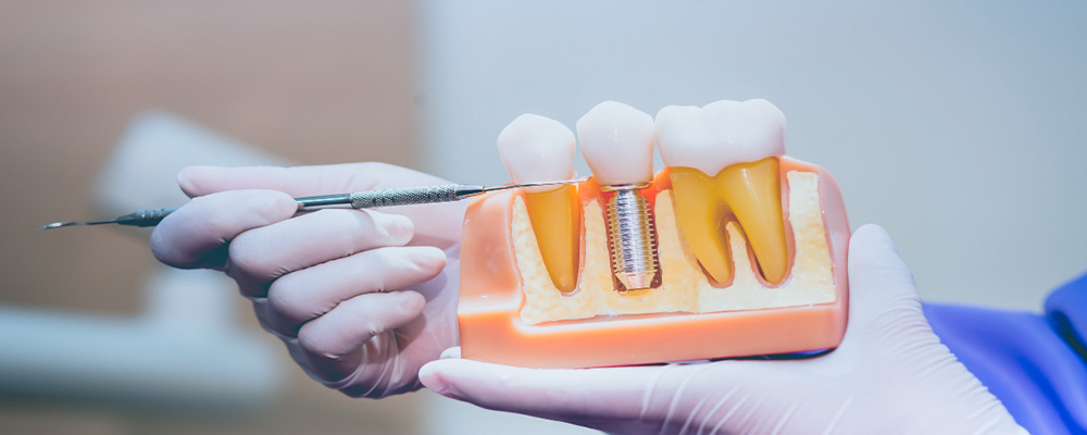 Diş implantı için en doğal madde nedir?