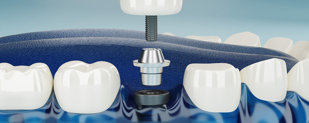 Diş Implantı Nasıl Yapılır?