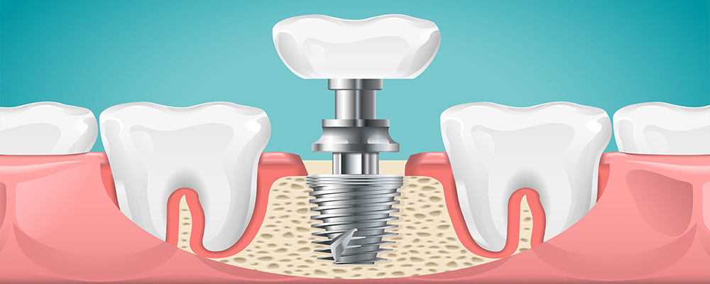 Diş implantlarının uygulama yerleri nerelerdir?