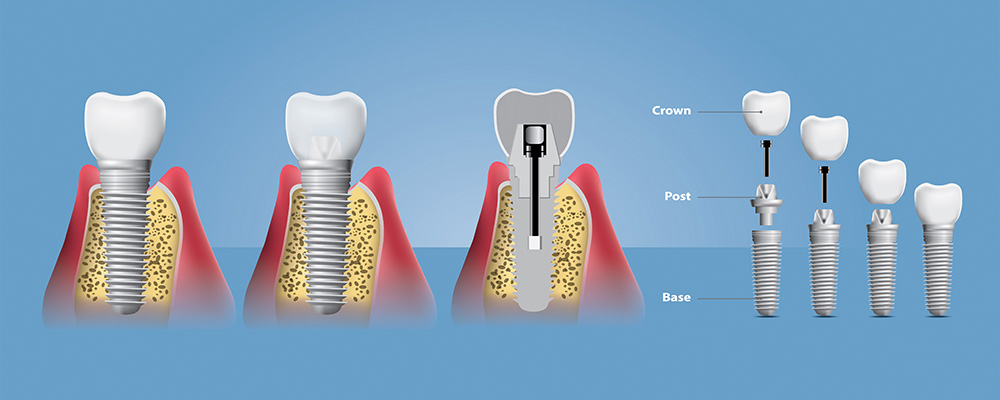 Implant diş tedavisi sonrasında bir sorun olursa nasıl anlaşılır?