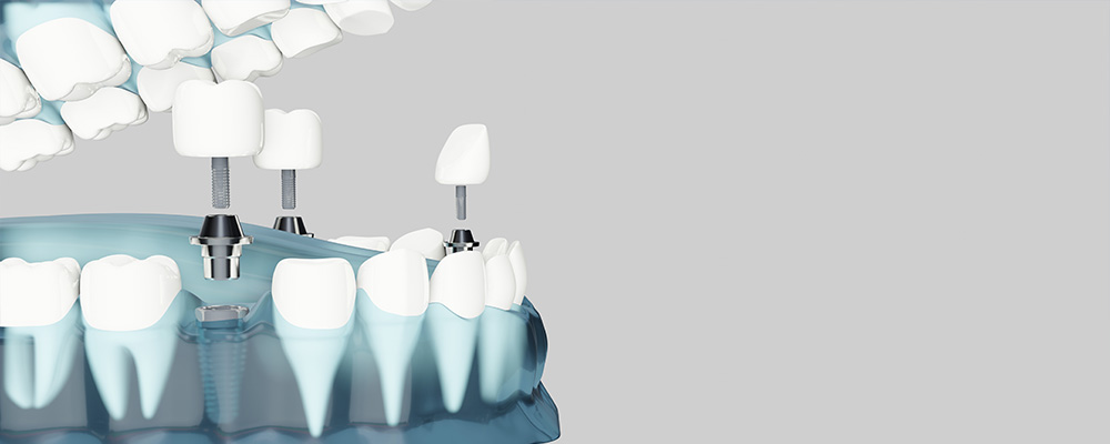 İmplant Üstü Diş Protezlerine Nasıl Karar Verilir?