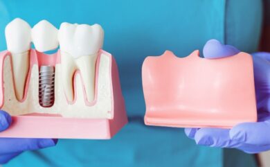 Preise für Ankara-Implantate