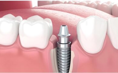How is a Sutured Implant Done?