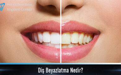 Qu'est-ce que le blanchiment des dents ?