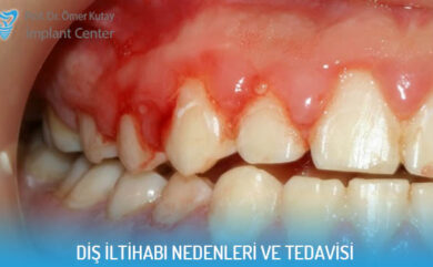 Ursachen und Behandlung von Zahninfektionen