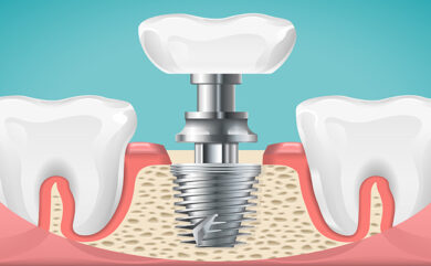 5 raisons de se faire nettoyer les dents