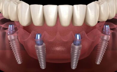 Wie erkennt man, ob ein zahnloser Bereich für ein Implantat geeignet ist?