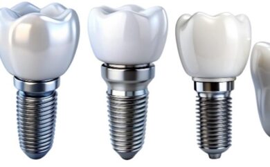 Best Implant Brands