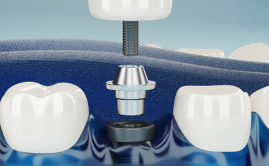 Stratifié esthétique