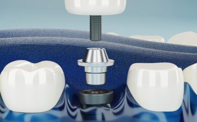 Aktuelle Implantatpreise