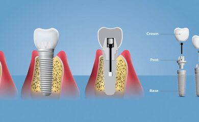 Können Implantate bei Menschen jeden Alters eingesetzt werden?