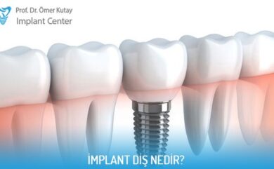 Was ist ein Zahnimplantat?