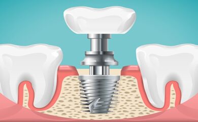 Wie pflegt man Implantatprothesen?