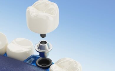 Festsitzender Zahnersatz mit Implantaten