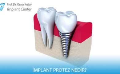 Was ist Implantatprothese?