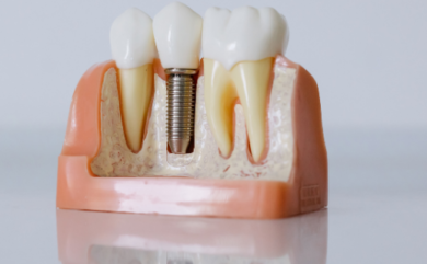 Nervenverletzung nach Implantation