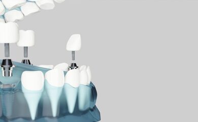 Häufig gestellte Fragen zu Implantaten und Porzellanzähnen