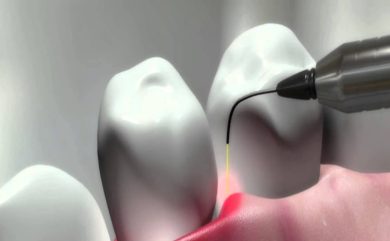 Wie hoch ist die Erfolgsrate einer Laserimplantatbehandlung?