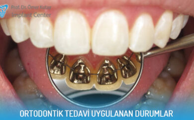 Situationen, in denen eine kieferorthopädische Behandlung angewendet wird