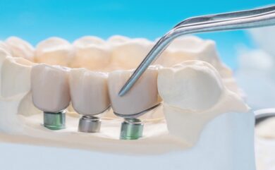 Implantatbehandlung bei vollständiger Zahnlosigkeit