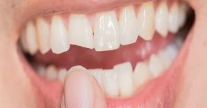 Porselen Kaplama Nedir?