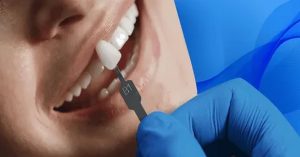 Porselen Kaplama Nedir?