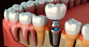 Dental İmplant Fiyatları