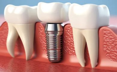 Dental İmplant Fiyatları