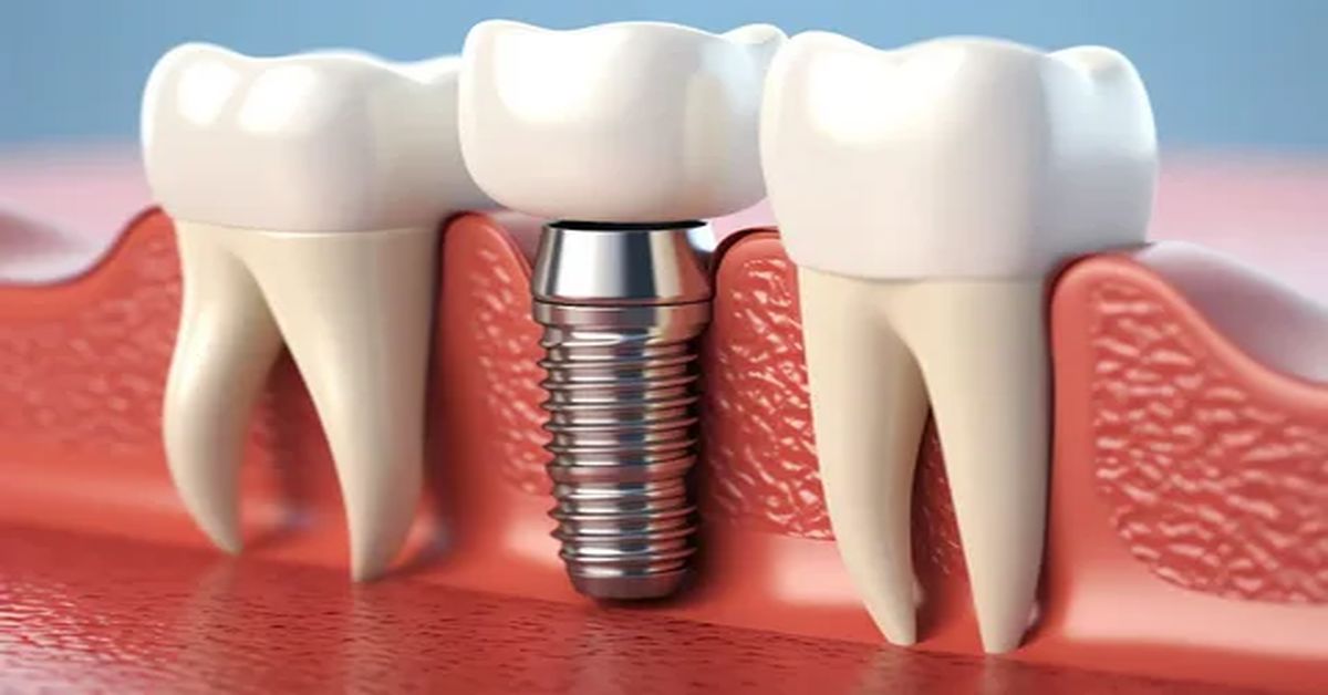 Dental İmplant Fiyatları