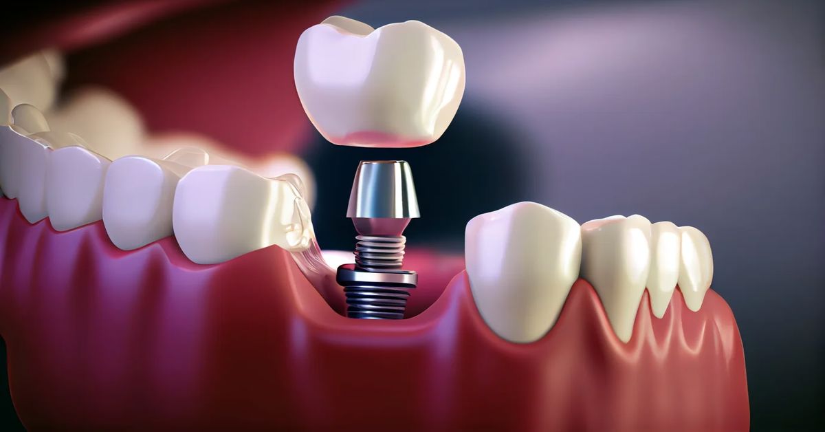 Dental İmplant Tedavisi