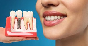 Dental İmplant Tedavisi