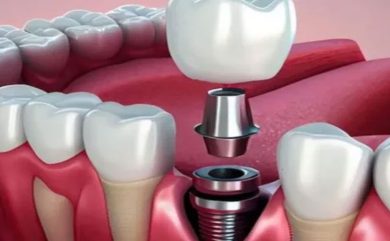İmplant Tedavisi Nedir?